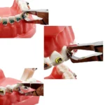 Orthodontic Bracket Removing Pliers - Image 6